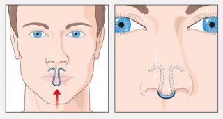 ClipAir Nasenspreizer gegen Schnarchen, verstopfte Nasen